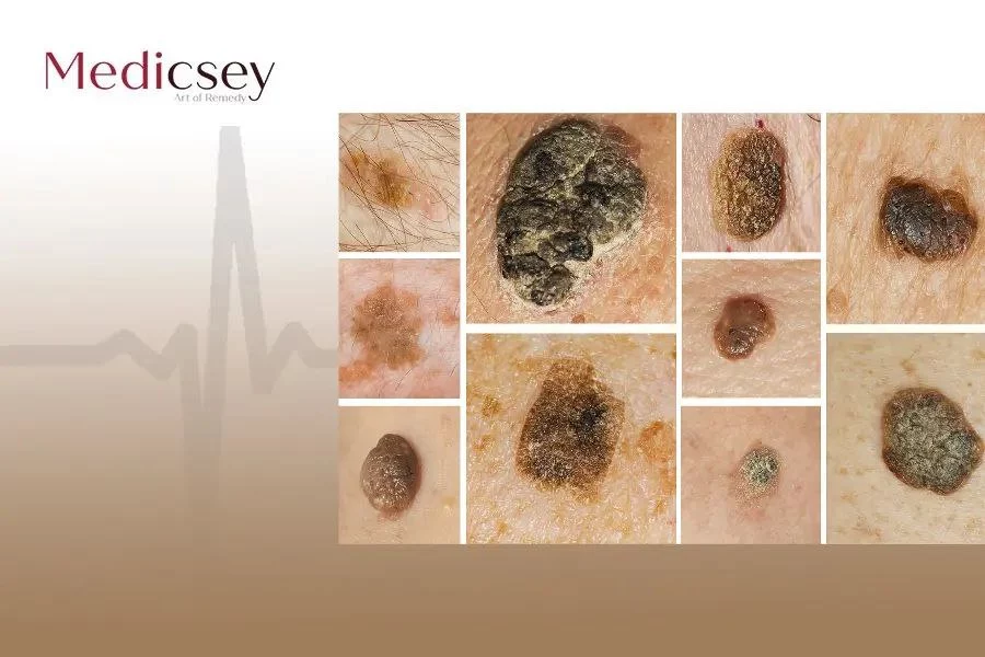 Seborrheic keratosis clearance